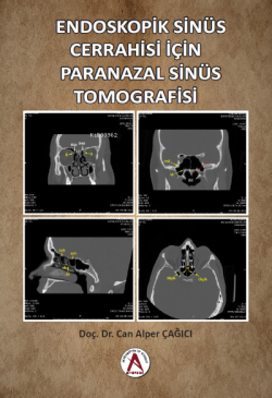 Endoskopik Sinüs Cerrahisi İçin Paranazal Sinüs Tomografisi - Nazan Öz